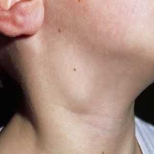 Lymphonoduses na vratu su upaljene. Što mogu učiniti kako bih olakšao stanje?