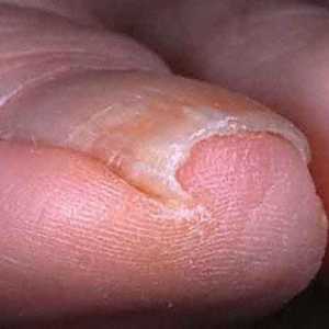 Uzgoj noktiju: liječenje i prevencija