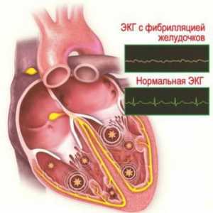 Ventrikularna aritmija srca: simptomi i liječenje
