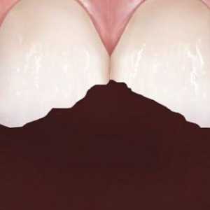 Zub se raspada - što da radimo? Stomatološko liječenje, stomatološki savjet