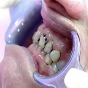 Zub se odmaknuo od desni: zašto se to događa i kako se nositi s tim?