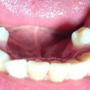 Zubni superkompleks: uzroci, simptomi i značajke liječenja