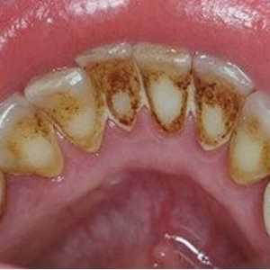 Zubni kamen - kako se riješiti? Zubne paste od tartara. Uklanjanje kamenca - recenzije