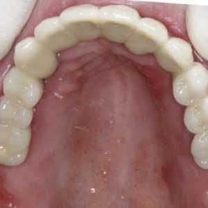 Dentures`Ari-Free`: opis, prednosti i nedostaci, recenzije stomatologa