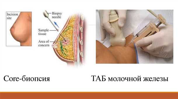 Biopsija pluća: oznaka postupka, ishod i posljedice